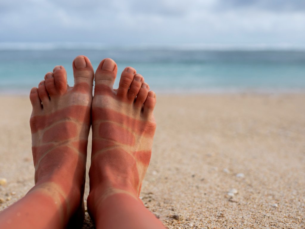 Prevención de Quemaduras en los Pies